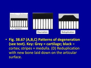 • Fig. 38.67 (A,B,C) Patterns of degeneration
(see text). Key: Grey = cartilage; black =
cortex; stripes = medulla. (D) Reduplication
with new bone laid down on the articular
surface.
Eburnation Reduplication
 
