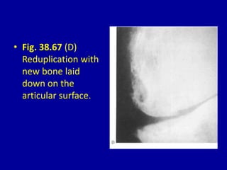 • Fig. 38.67 (D)
Reduplication with
new bone laid
down on the
articular surface.
 