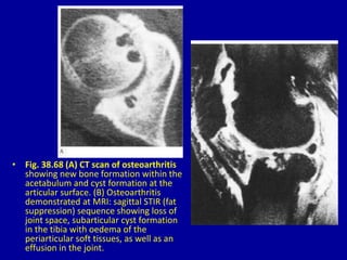 • Fig. 38.68 (A) CT scan of osteoarthritis
showing new bone formation within the
acetabulum and cyst formation at the
articular surface. (B) Osteoarthritis
demonstrated at MRI: sagittal STIR (fat
suppression) sequence showing loss of
joint space, subarticular cyst formation
in the tibia with oedema of the
periarticular soft tissues, as well as an
effusion in the joint.
 