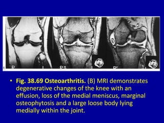 • Fig. 38.69 Osteoarthritis. (B) MRI demonstrates
degenerative changes of the knee with an
effusion, loss of the medial meniscus, marginal
osteophytosis and a large loose body lying
medially within the joint.
 