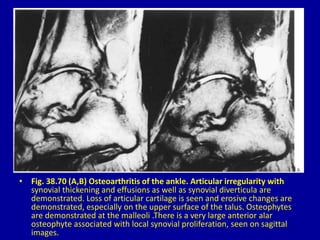 • Fig. 38.70 (A,B) Osteoarthritis of the ankle. Articular irregularity with
synovial thickening and effusions as well as synovial diverticula are
demonstrated. Loss of articular cartilage is seen and erosive changes are
demonstrated, especially on the upper surface of the talus. Osteophytes
are demonstrated at the malleoli .There is a very large anterior alar
osteophyte associated with local synovial proliferation, seen on sagittal
images.
 