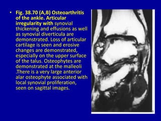 • Fig. 38.70 (A,B) Osteoarthritis
of the ankle. Articular
irregularity with synovial
thickening and effusions as well
as synovial diverticula are
demonstrated. Loss of articular
cartilage is seen and erosive
changes are demonstrated,
especially on the upper surface
of the talus. Osteophytes are
demonstrated at the malleoli
.There is a very large anterior
alar osteophyte associated with
local synovial proliferation,
seen on sagittal images.
 