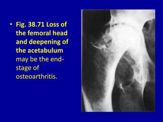 • Fig. 38.71 Loss of
the femoral head
and deepening of
the acetabulum
may be the end-
stage of
osteoarthritis.
 