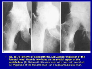 • Fig. 38.72 Patterns of osteoarthritis. (A) Superior migration of the
femoral head. There is new bone on the medial aspect of the
acetabulum. (B) Osteoarthritis associated with protrusio acetabuli.
(C) Migration of the femoral head is in a superomedial direction.
 