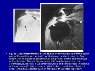 • Fig. 38.73 (A) Osteoarthritis of the shoulder-note excavation of the upper
part of the anatomical neck with local sclerosis, and cysts seen en face
(arrow). (B) Widespread abnormalities are present on this coronal image
of the shoulder. There is degeneration with an effusion around the
acromioclavicular joint, a subacromial bursitis and considerable thickening
of the rotator cuff, which shows a cyst in its body. In addition, there is a
distal tendinitis associated with an erosion of the greater tuberosity.
 