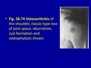 • Fig. 38.74 Osteoarthritis of
the shoulder, classic type-loss
of joint space, eburnation,
cyst formation and
osteophytosis shown.
 