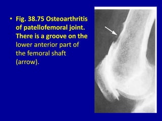 • Fig. 38.75 Osteoarthritis
of patellofemoral joint.
There is a groove on the
lower anterior part of
the femoral shaft
(arrow).
 