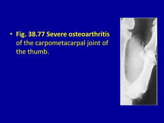 • Fig. 38.77 Severe osteoarthritis
of the carpometacarpal joint of
the thumb.
 