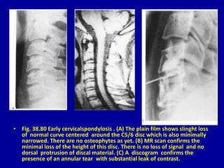 • Fig. 38.80 Early cervicalspondylosis . (A) The plain film shows slinght loss
of normal curve centered around the C5/6 disc which is also minimally
narrowed. There are no osteophytes as yet. (B) MR scan confirms the
minimal loss of the height of this disc. There is no loss of signal and no
dorsal protrusion of discal material. (C) A discogram confirms the
presence of an annular tear with substantial leak of contrast.
 