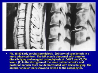 • Fig. 38.80 Early cervicalspondylosis . (D) cervical spondylosis in a
more advanced form. The MR scan is abnormal with anterior
discal bulging and marginal osteophytosis at C4/C5 and C5/C6
levels. (E) In the discogram of the same patient anterior and
posterior annular tears are demonstrated with dorsal bulging. The
anterior annular tears shown to extend to the osteophytes.
 