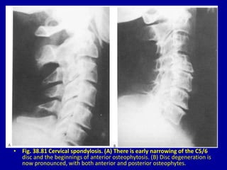 • Fig. 38.81 Cervical spondylosis. (A) There is early narrowing of the C5/6
disc and the beginnings of anterior osteophytosis. (B) Disc degeneration is
now pronounced, with both anterior and posterior osteophytes.
 