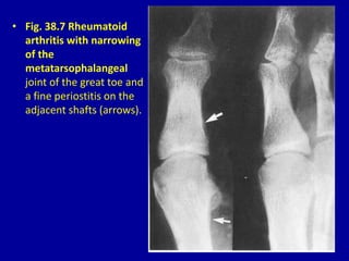 • Fig. 38.7 Rheumatoid
arthritis with narrowing
of the
metatarsophalangeal
joint of the great toe and
a fine periostitis on the
adjacent shafts (arrows).
 