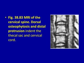 • Fig. 38.83 MRI of the
cervical spine. Dorsal
osteophytosis and distal
protrusion indent the
thecal sac and cervical
cord.
 