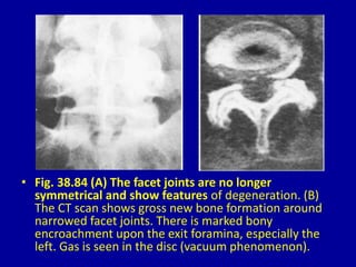 • Fig. 38.84 (A) The facet joints are no longer
symmetrical and show features of degeneration. (B)
The CT scan shows gross new bone formation around
narrowed facet joints. There is marked bony
encroachment upon the exit foramina, especially the
left. Gas is seen in the disc (vacuum phenomenon).
 