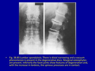 • Fig. 38.85 Lumbar spondylosis. There is distal narrowing and a vacuum
phenomenon is present in the degenerative discs. Marginal osteophytes
are present. Inferiorly the facet joints show features of degeneration and,
with the increase in lordosis, the spinous processes are in contact.
 