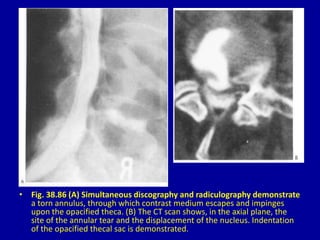 • Fig. 38.86 (A) Simultaneous discography and radiculography demonstrate
a torn annulus, through which contrast medium escapes and impinges
upon the opacified theca. (B) The CT scan shows, in the axial plane, the
site of the annular tear and the displacement of the nucleus. Indentation
of the opacified thecal sac is demonstrated.
 