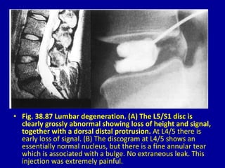 • Fig. 38.87 Lumbar degeneration. (A) The L5/S1 disc is
clearly grossly abnormal showing loss of height and signal,
together with a dorsal distal protrusion. At L4/5 there is
early loss of signal. (B) The discogram at L4/5 shows an
essentially normal nucleus, but there is a fine annular tear
which is associated with a bulge. No extraneous leak. This
injection was extremely painful.
 