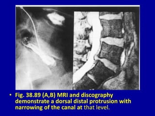 • Fig. 38.89 (A,B) MRI and discography
demonstrate a dorsal distal protrusion with
narrowing of the canal at that level.
 