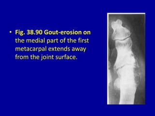 • Fig. 38.90 Gout-erosion on
the medial part of the first
metacarpal extends away
from the joint surface.
 