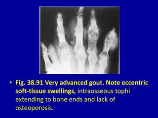 • Fig. 38.91 Very advanced gout. Note eccentric
soft-tissue swellings, intraosseous tophi
extending to bone ends and lack of
osteoporosis.
 