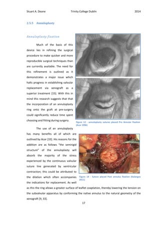 Stuart A. Deane Trinity College Dublin 2014
17
2.5.5 Annuloplasty
Annuloplasty fixation
Much of the basis of this
device lies in refining the surgical
procedure to make quicker and more
reproducible surgical techniques than
are currently available. The need for
this refinement is outlined as it
demonstrates a major issue which
halts progress in establishing valvular
replacement via xenograft as a
superior treatment [15]. With this in
mind this research suggests that that
the incorporation of an annuloplasty
ring onto the graft at pre-surgery
could significantly reduce time spent
choosing and fitting during surgery.
The use of an annuloplasty
has many benefits all of which are
outlined by Acar [33]. His reasons for the
addition are as follows “the semirigid
structure” of the annuloplasty will
absorb the majority of the stress
experienced by the continuous valvular
suture line generated by ventricular
contraction; this could be attributed to
the dilation which often accompanies
the indications for replacement. As well
as this the ring allows a greater surface of leaflet coaptation, thereby lowering the tension on
the subvalvular apparatus by conforming the native annulus to the natural geometry of the
xenograft [9, 33].
Figure 14 - Suture placed Post annulus fixation (Kalangos
2011)
Figure 13 - annuloplasty sutures placed Pre Annular fixation
(Acar 1996)
 