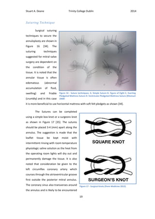 Stuart A. Deane Trinity College Dublin 2014
19
Suturing Technique
Surgical suturing
techniques to secure the
annuloplasty are shown in
Figure 16 [34]. The
suturing techniques
suggested for mitral valve
surgery are dependent on
the condition of the
tissue. It is noted that the
annular tissue is often
edematous (abnormal
accumulation of fluid,
swelling) and friable
(crumbly) and in this case
it is more beneficial to use horizontal mattress with soft felt pledgets as shown [34].
The Sutures can be completed
using a simple box knot or a surgeons knot
as shown in Figure 17 [35]. The sutures
should be placed 3-4 (mm) apart along the
annulus. The suggestion is made that the
leaflet tissue be kept moist with
intermittent rinsing with room temperature
physiologic saline solution as the heat from
the operating room lights will dry out and
permanently damage the tissue. It is also
noted that consideration be given to the
left circumflex coronary artery which
courses through the atrioventricular groove
first outside the posterior mitral annulus.
The coronary sinus also transverses around
the annulus and is likely to be encountered
Figure 16 - Suture techniques; A. Simple Suture B. Figure of Eight C. Everting
Pledgeted Mattress Suture D. Ventricular Pledgeted Mattress Suture (Khonsari
2008)
Figure 17 - Surgical Knots (Penn Medicine 2013)
 
