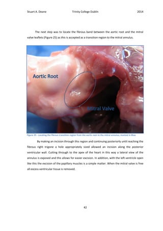 Stuart A. Deane Trinity College Dublin 2014
42
The next step was to locate the fibrous band between the aortic root and the mitral
valve leaflets (Figure 25) as this is accepted as a transition region to the mitral annulus.
By making an incision through this region and continuing posteriorly until reaching the
fibrous right trigone a hole appropriately sized allowed an incision along the posterior
ventricular wall. Cutting through to the apex of the heart in this way a lateral view of the
annulus is exposed and this allows for easier excision. In addition, with the left ventricle open
like this the excision of the papillary muscles is a simple matter. When the mitral valve is free
all excess ventricular tissue is removed.
Figure 25 - Locating the fibrous transition region from the aortic root to the mitral annulus; marked in Blue
 
