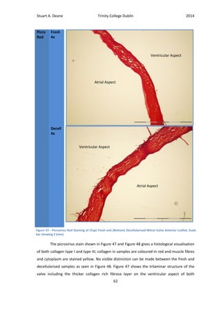 Stuart A. Deane Trinity College Dublin 2014
62
Picro
Red
Fresh
4x
Decell
4x
The picrosirius stain shown in Figure 47 and Figure 48 gives a histological visualisation
of both collagen type I and type III; collagen in samples are coloured in red and muscle fibres
and cytoplasm are stained yellow. No visible distinction can be made between the fresh and
decellularised samples as seen in Figure 48. Figure 47 shows the trilaminar structure of the
valve including the thicker collagen rich fibrosa layer on the ventricular aspect of both
Figure 47 - Picrosirius Red Staining of (Top) Fresh and (Bottom) Decellularised Mitral Valve Anterior Leaflet, Scale
bar showing 2 (mm)
Atrial Aspect
Ventricular Aspect
Atrial Aspect
Ventricular Aspect
 