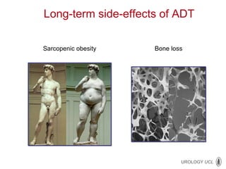 Bone loss Sarcopenic obesity Long-term side-effects of ADT 