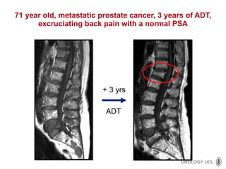 71 year old, metastatic prostate cancer, 3 years of ADT, excruciating back pain with a normal PSA + 3 yrs ADT 