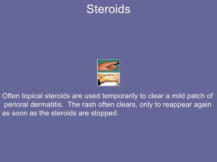 Slow Treatment with Topical Antibiotic for Perioral Dermatitis