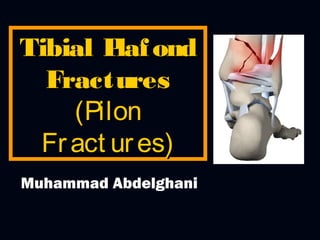 Tibial P ond
laf
Fractures
(Pilon
Fr act ur es)
Muhammad Abdelghani

 