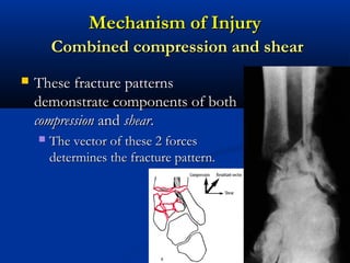 Mechanism of Injury
Combined compression and shear


These fracture patterns
demonstrate components of both
compression and shear.


The vector of these 2 forces
determines the fracture pattern.

 