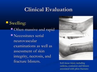 Clinical Evaluation


Swelling:
 Often massive and rapid
 Necessitates serial

neurovascular
examinations as well as
assessment of skin
integrity, necrosis, and
fracture blisters.

Soft tissue injury including
oedema, contusion and blisters
associated with pilon fractures

 
