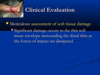 Clinical Evaluation


Meticulous assessment of soft tissue damage
 Significant damage occurs to the thin soft

tissue envelope surrounding the distal tibia as
the forces of impact are dissipated.

 