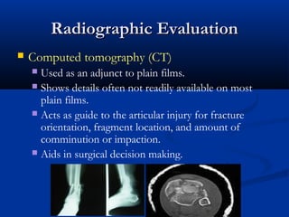 Radiographic Evaluation


Computed tomography (CT)
Used as an adjunct to plain films.
 Shows details often not readily available on most
plain films.
 Acts as guide to the articular injury for fracture
orientation, fragment location, and amount of
comminution or impaction.
 Aids in surgical decision making.


 