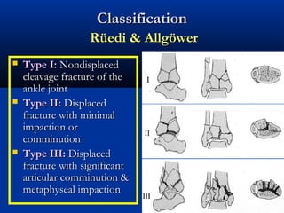 Classification
Rüedi & Allgöwer






Type I: Nondisplaced
cleavage fracture of the
ankle joint
Type II: Displaced
fracture with minimal
impaction or
comminution
Type III: Displaced
fracture with significant
articular comminution &
metaphyseal impaction

 