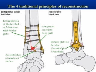 The 4 traditional principles of reconstruction

 
