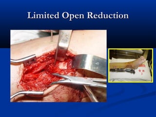 Limited Open Reduction

 