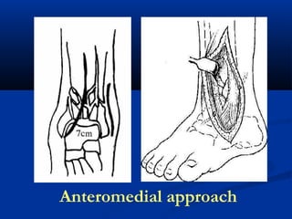 Anteromedial approach

 