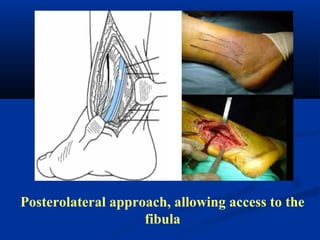 Posterolateral approach, allowing access to the
fibula

 