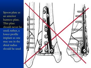 Spoon plate as
an anterior
buttress plate.
This plate
should never be
used; rather, a
lower profile
implant as one
may use in the
distal radius
should be used

 