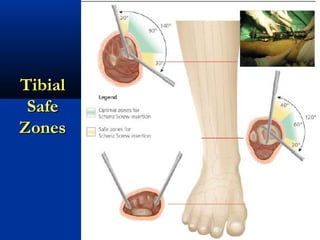 Tibial
Safe
Zones

 