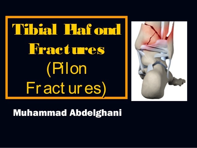 39 Tibial Plafond Pilon Fractures 39 Tibial Plafond Pilon Fractures