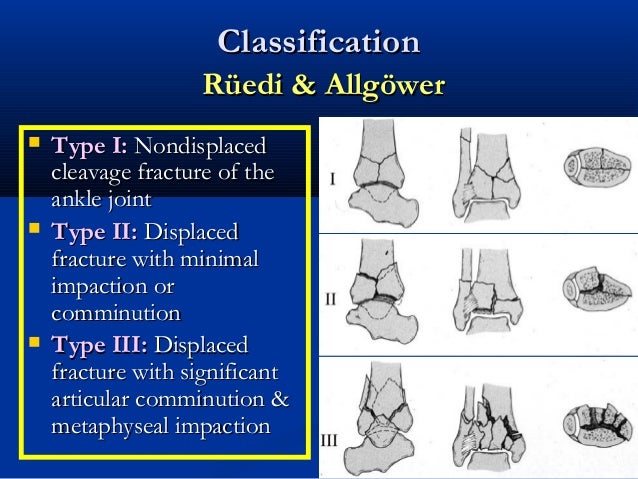 39 Tibial Plafond Pilon Fractures