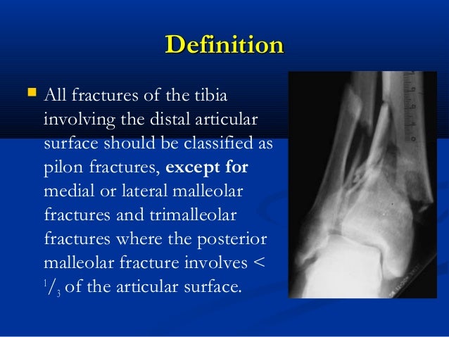 Define tibial plafond anatomy