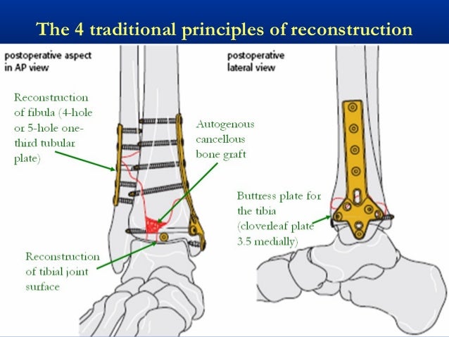 39 Tibial Plafond Pilon Fractures