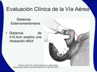 Evaluación Clínica de la Vía Aérea
       Distancia
   Esternomentoniana

• Distancia          de
  ≤12.5cm predice una
  intubación difícil




           White A, Kander PL. Anatomical factors in difficult direct
    laryngoscopy. British Journal of Anesthesia 47: 468-474 (1975)
 