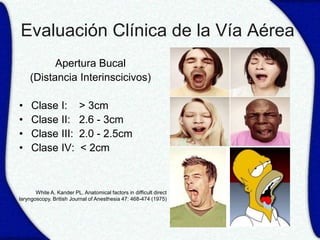 Evaluación Clínica de la Vía Aérea
          Apertura Bucal
    (Distancia Interinscicivos)

•    Clase I:             > 3cm
•    Clase II:            2.6 - 3cm
•    Clase III:           2.0 - 2.5cm
•    Clase IV:            < 2cm



       White A, Kander PL. Anatomical factors in difficult direct
laryngoscopy. British Journal of Anesthesia 47: 468-474 (1975)
 