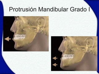 Protrusión Mandibular Grado I
 